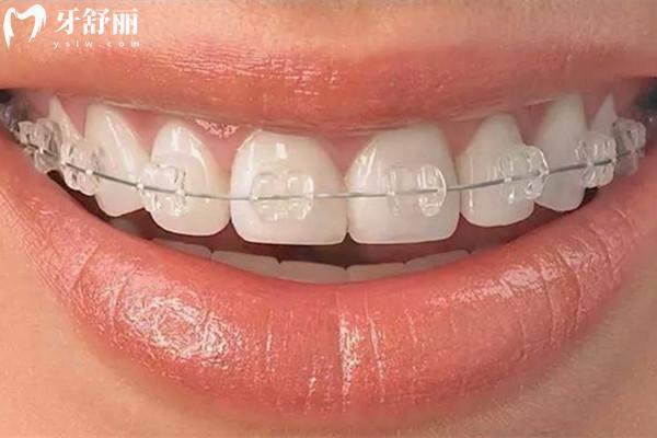 陶瓷托槽隱形牙齒矯正
