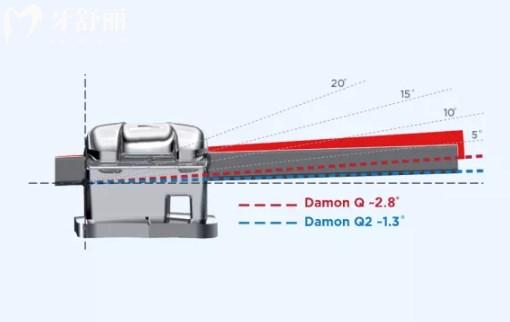 Damon Q2自鎖托槽技術(shù)優(yōu)勢(shì)