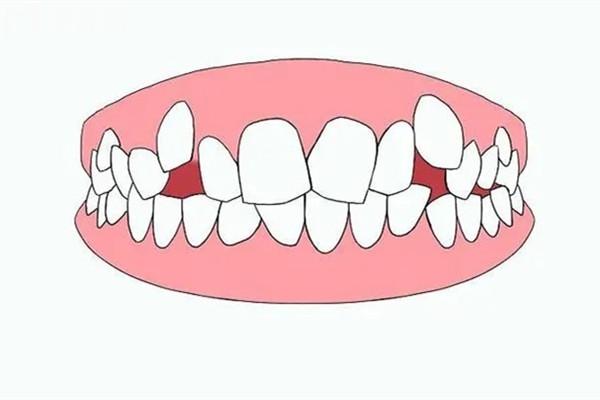 牙齒不齊矯正