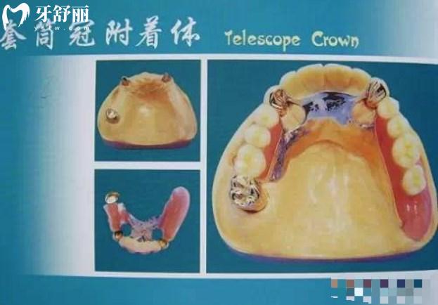 套筒冠附著體