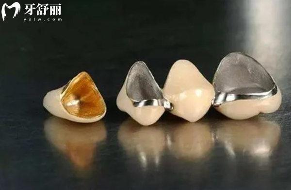 天津**烤瓷牙多少錢一顆