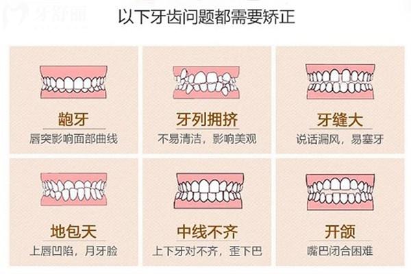 牙齒矯正可以解決的問題