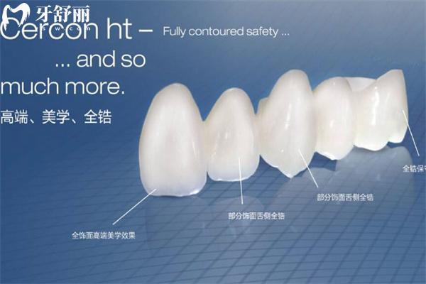 德國澤康(Cercon)全瓷牙冠