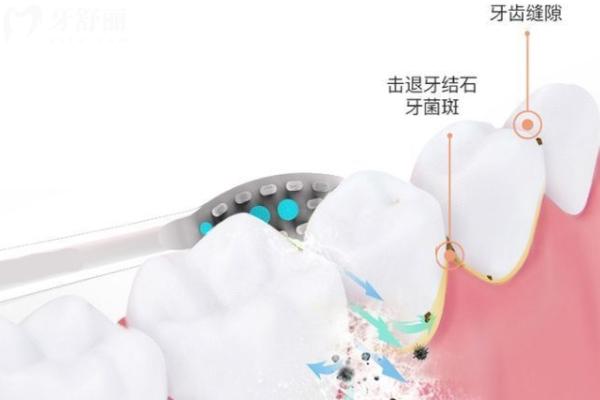 電動(dòng)牙刷怎么選擇有什么講究