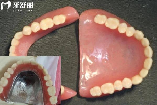 老人裝全口樹脂牙多少錢