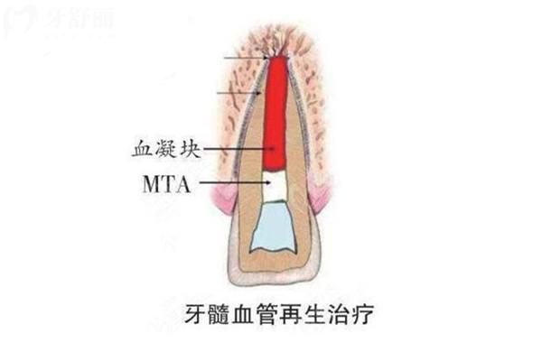 什么是牙髓**術(shù)