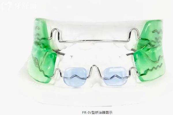 FR-IV型矯治器