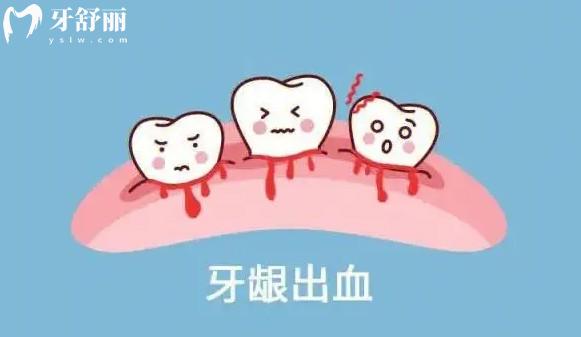 預防牙齦出血的小知識有哪些