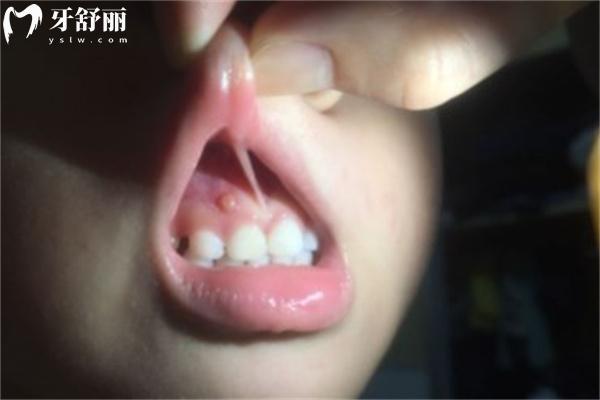 牙齦腫起來一個肉包特別疼一按就出血什么原因？