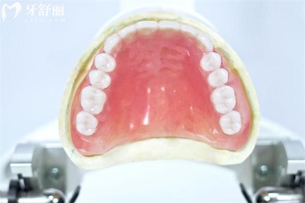 舒士德吸附性義齒
