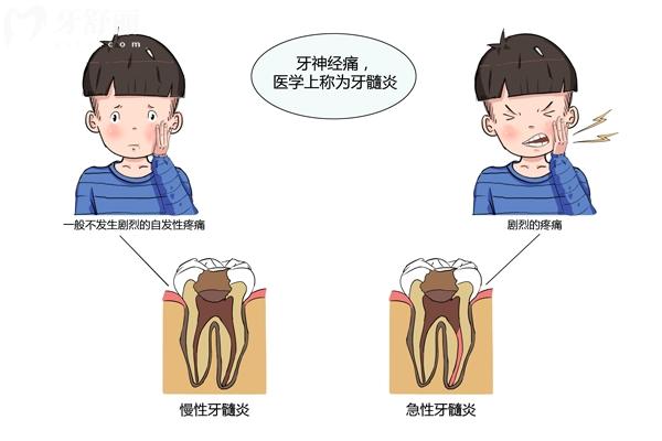 急性牙髓炎和慢性牙髓炎有什么區(qū)別？