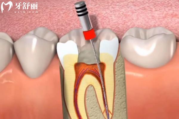 急性牙髓炎和慢性牙髓炎有什么區(qū)別？