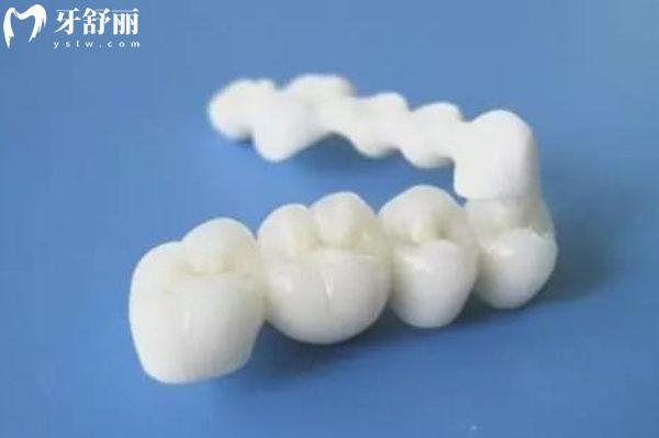 鑲牙大概多少錢(qián)一顆
