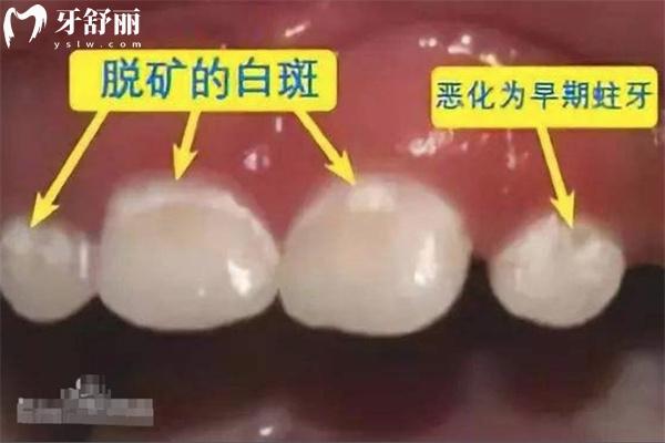 牙齒脫礦是什么原因造成的