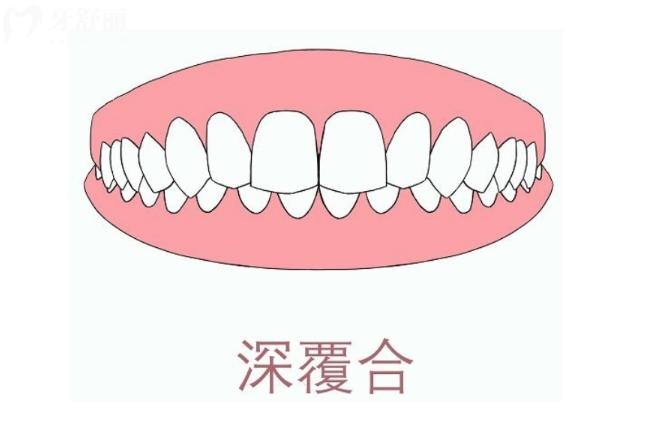深覆合不矯正將來會咋樣