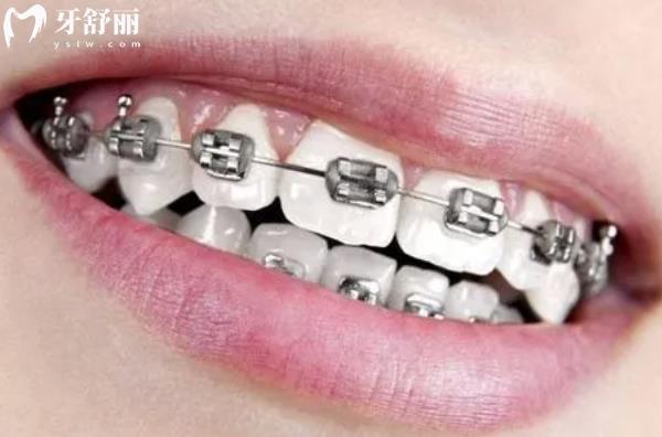 牙齒深覆合不矯正會怎么樣