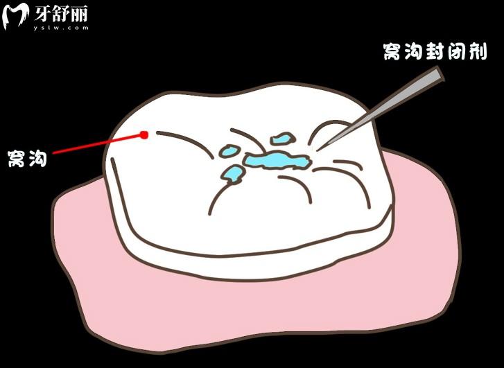窩溝齲怎么治療