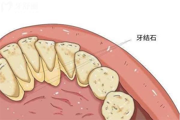 一般洗牙需要多長時間?多少錢?
