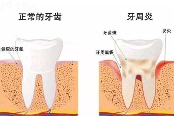 糖尿病牙周炎怎么治療有效
