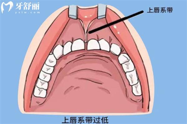 笑露牙齦與唇系帶有關(guān)系嗎？
