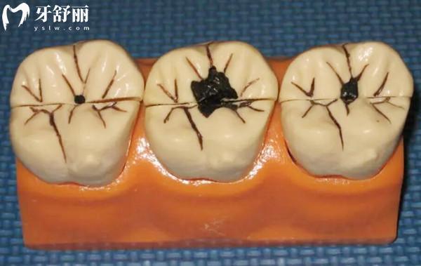 補(bǔ)牙去三 甲醫(yī)院還是牙科診所