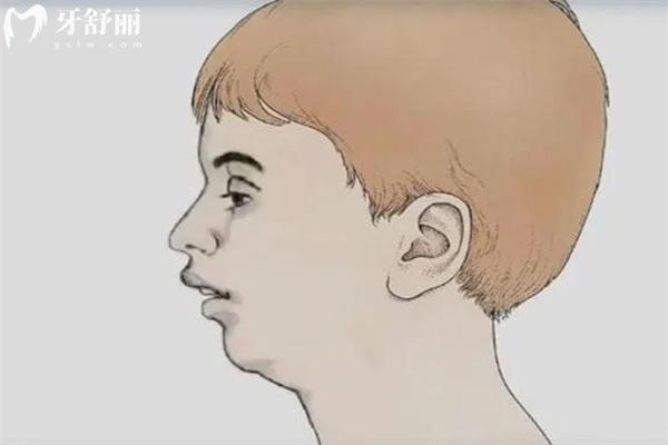 腺樣體面容和凸嘴怎么區(qū)分