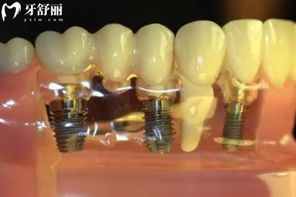 種植牙種什么材質(zhì)的好？