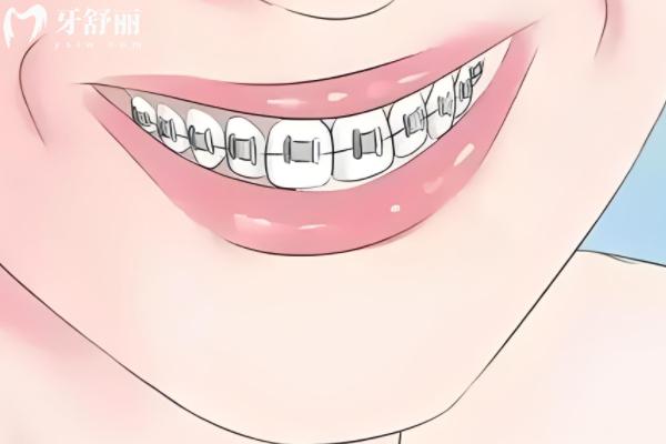 義烏牙齒矯正便宜的牙科