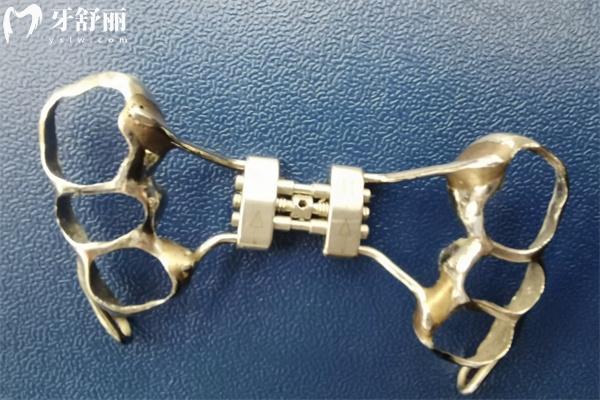 牙齒擴弓器需要多少錢