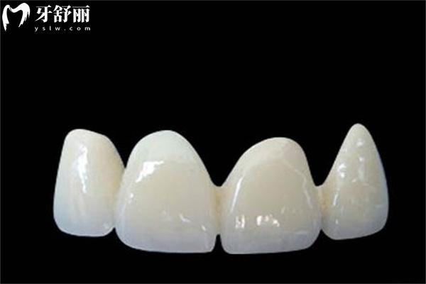 德國貝格鈷鉻烤瓷牙