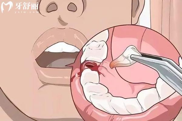 拔牙后吃冰激凌不會污染傷口嗎？