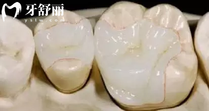 嵌體有哪些材質(zhì)？哪種比較好？