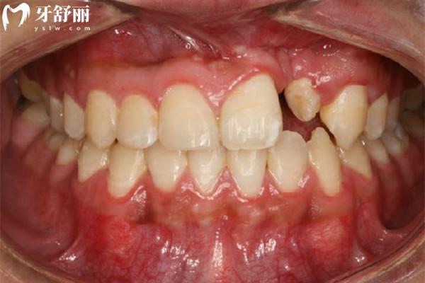 做過腭裂手術(shù)還能做牙齒矯正嗎