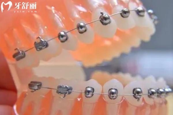 球形自鎖托槽牙套