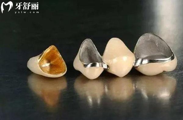 西寧鑲烤瓷牙價(jià)格多少錢(qián)一顆？