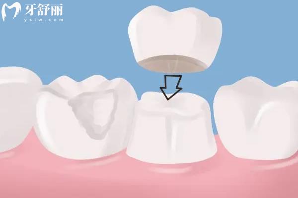 殺神經(jīng)和根管治療是一回事嗎？