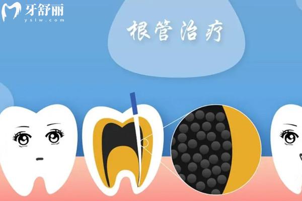 根管治療為啥前牙和后牙的價格不一樣？