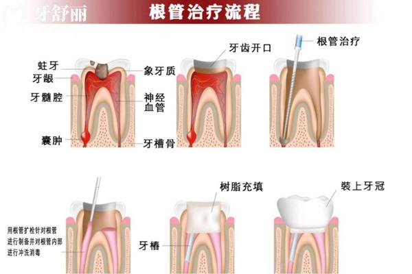 根管治療為啥前牙和后牙的價格不一樣？