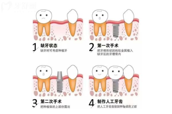 20多歲種植牙好還是做冠好？