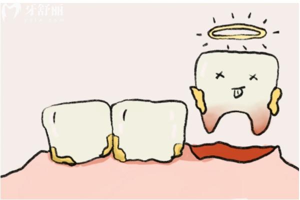 先洗牙還是先拔牙補牙？