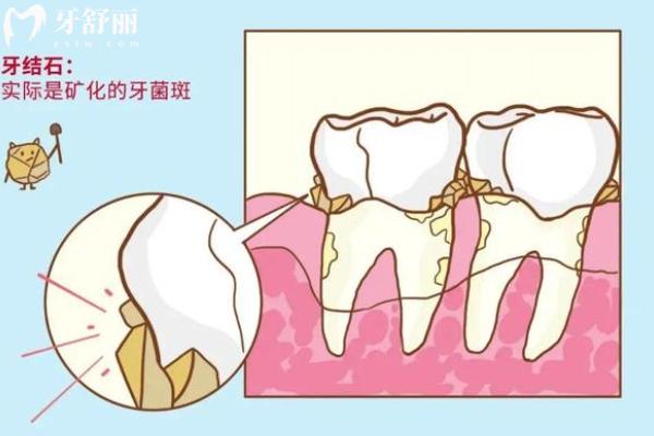 先洗牙還是先拔牙補牙？
