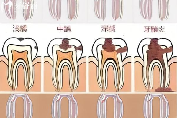 先洗牙還是先拔牙補牙？