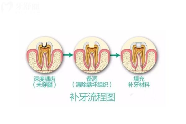十歲孩子補(bǔ)牙，長(zhǎng)大后還需要補(bǔ)嗎