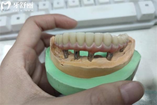 老年人牙齒掉光了裝什么假牙合適?價(jià)格一般多少錢？