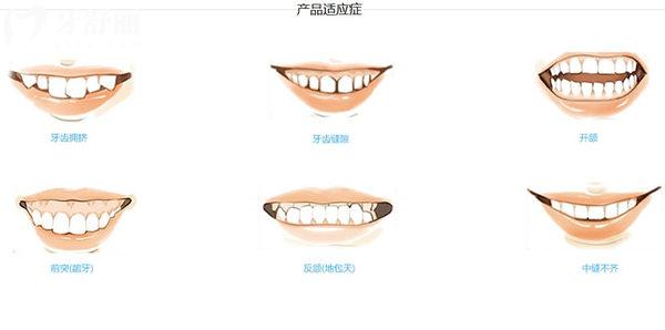 愛美適隱形牙套適應(yīng)癥