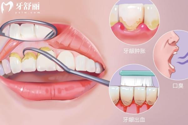 在家超聲波洗牙靠譜嗎？