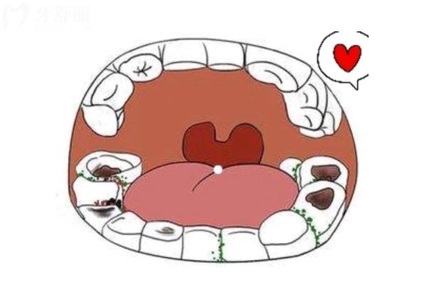 蛀牙不疼也要補(bǔ)是過度醫(yī)療嗎？