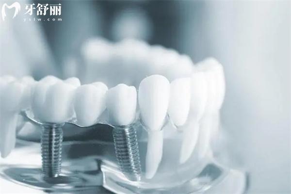 深圳裝全口假牙價格表