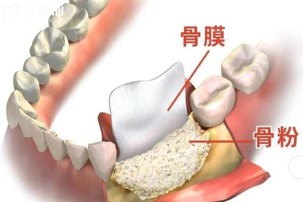 金華口腔醫(yī)院種植牙集采價格收費