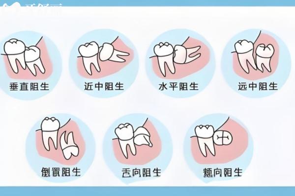 ?？诎窝蓝嗌馘X一顆